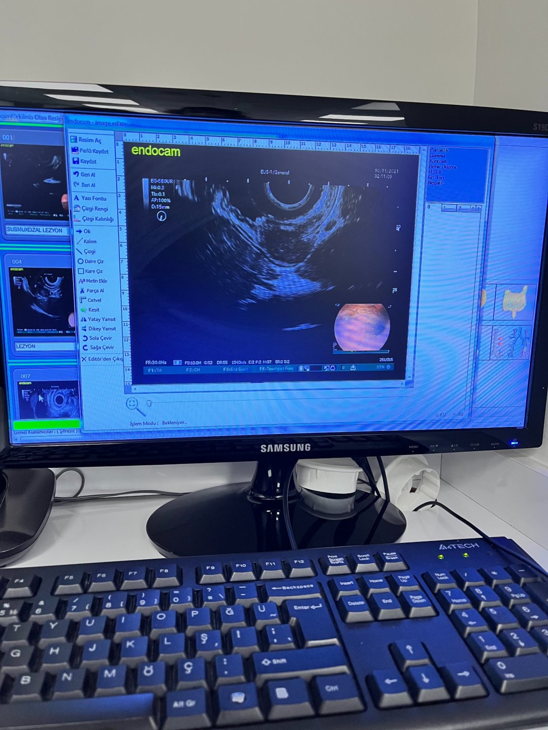 WHAT IS ENDOSCOPY AND ENDOSONOGRAPHY PROCEDURES DR. SUAT OZDEN GASTROINTESTINAL ENDOSCOPY